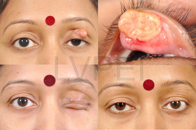 Eyelid Cancer Reconstruction